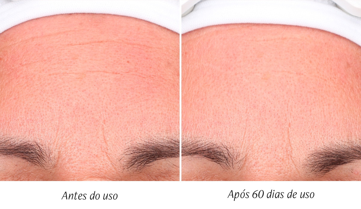 antes e depois beauty structure 1 beauty structure