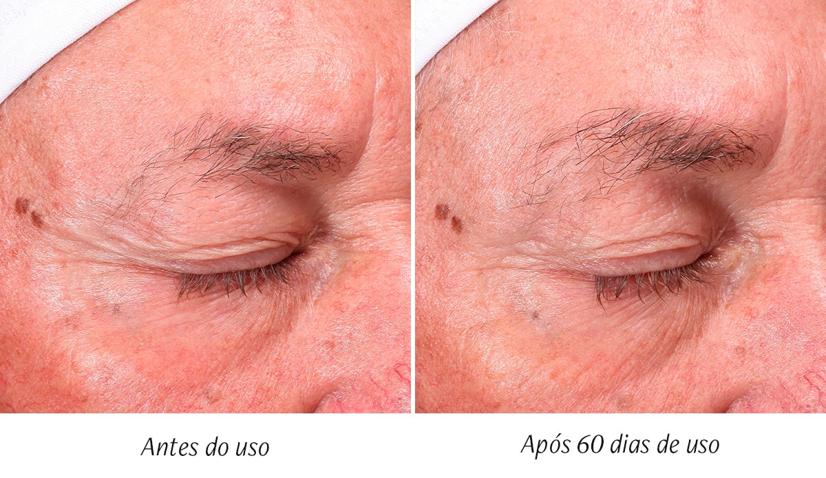 antes e depois beauty structure 2 beauty structure