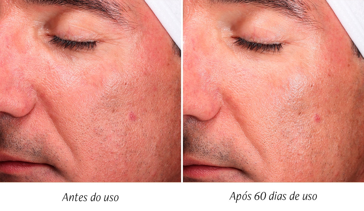 antes e depois beauty structure beauty structure
